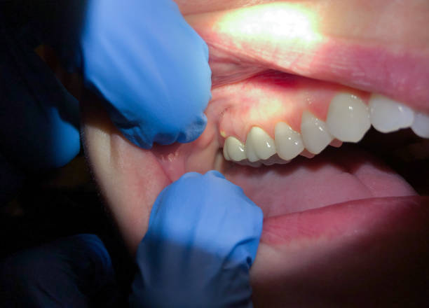 Best Emergency Tooth Extraction in Medford, MA
